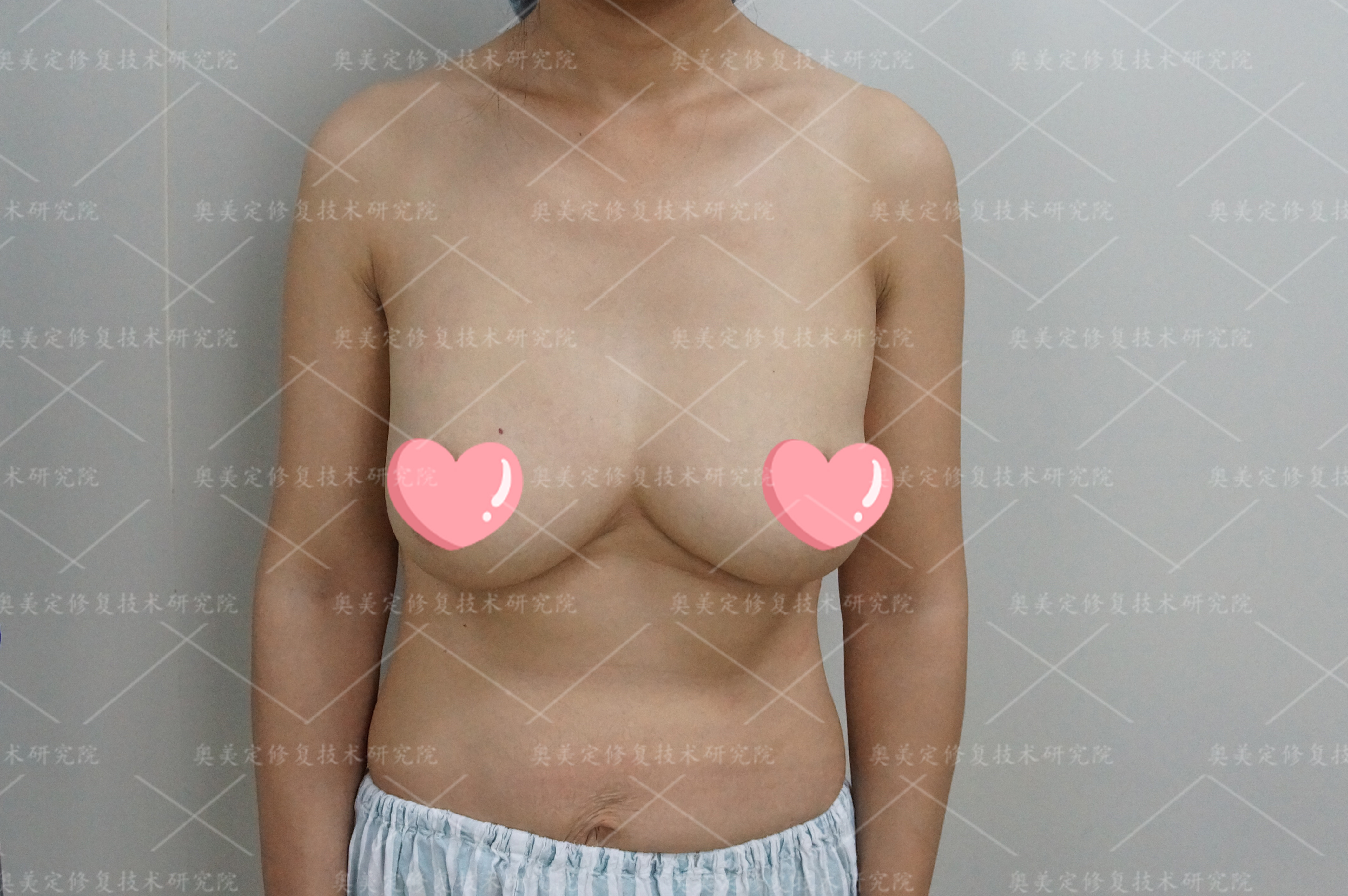 胸部奥美定注射后还能取出修复吗