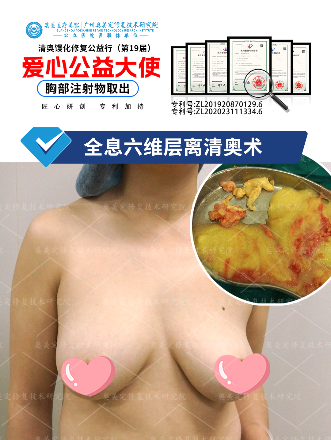 胸部注射了奥美定要取出吗？