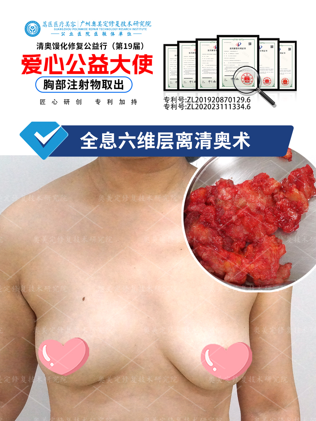 奥美定隆胸20年后取出修复