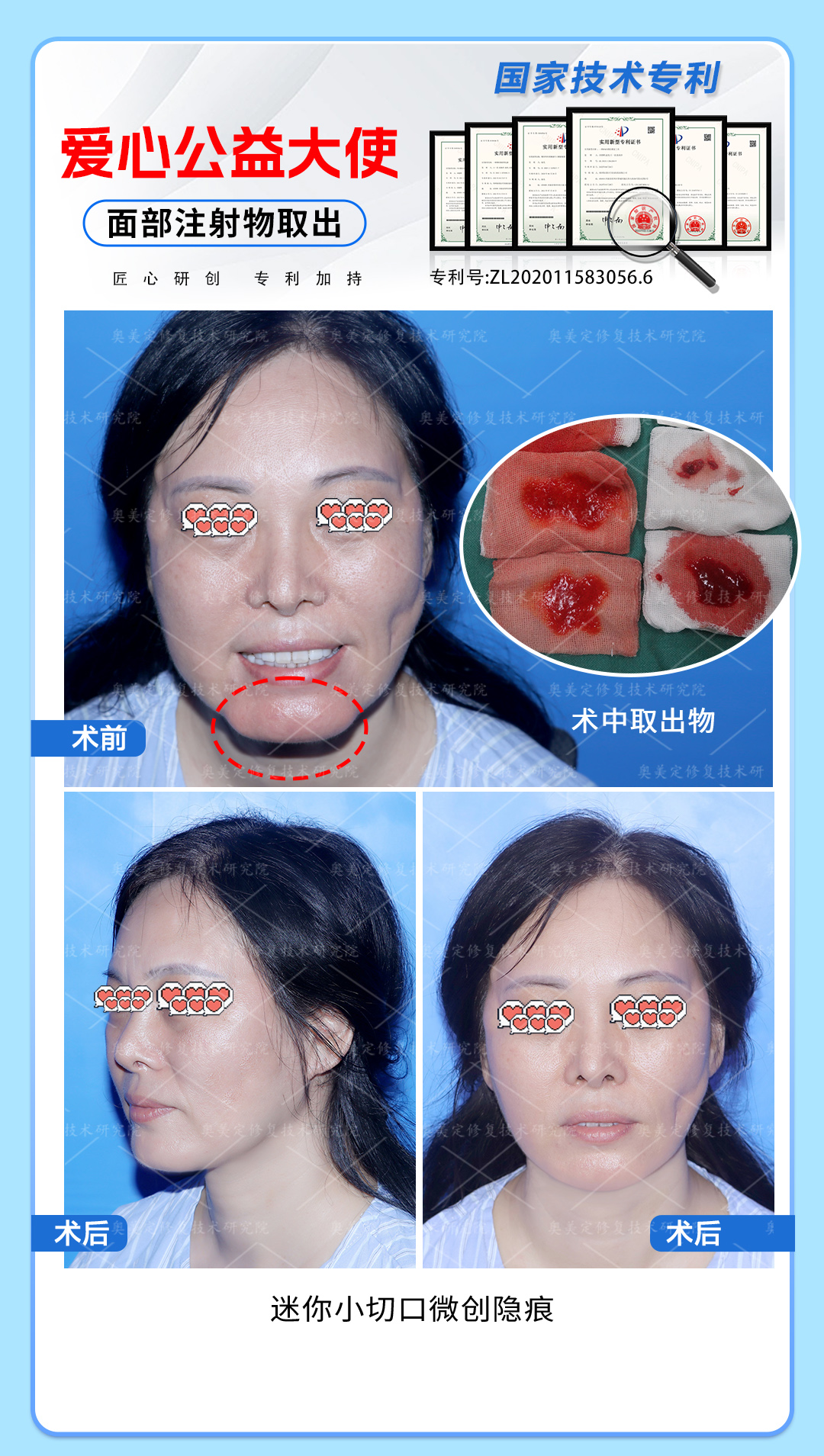 下巴注射生长因子后如何取出修复