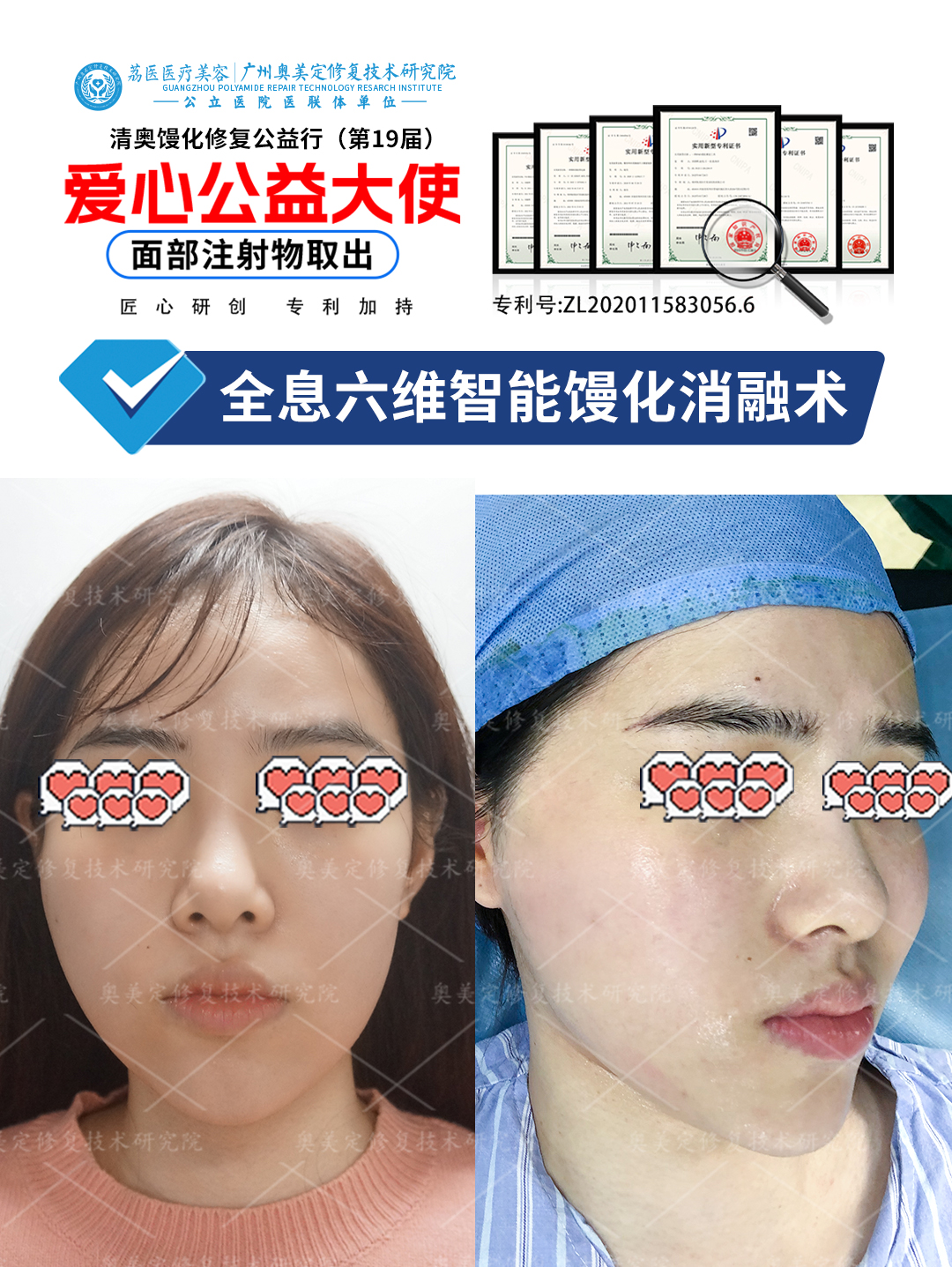 苹果肌注射非法材料后还能取出吗