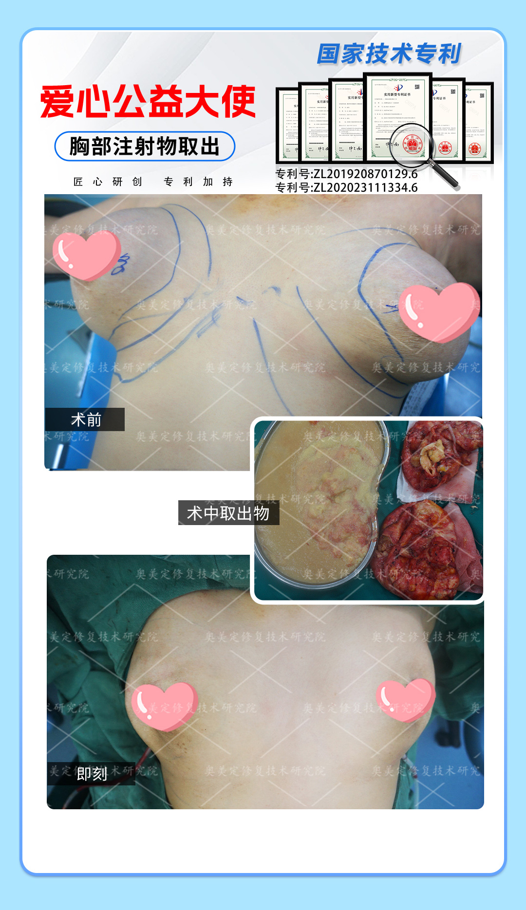 奥美定隆胸15年后来院取出修复