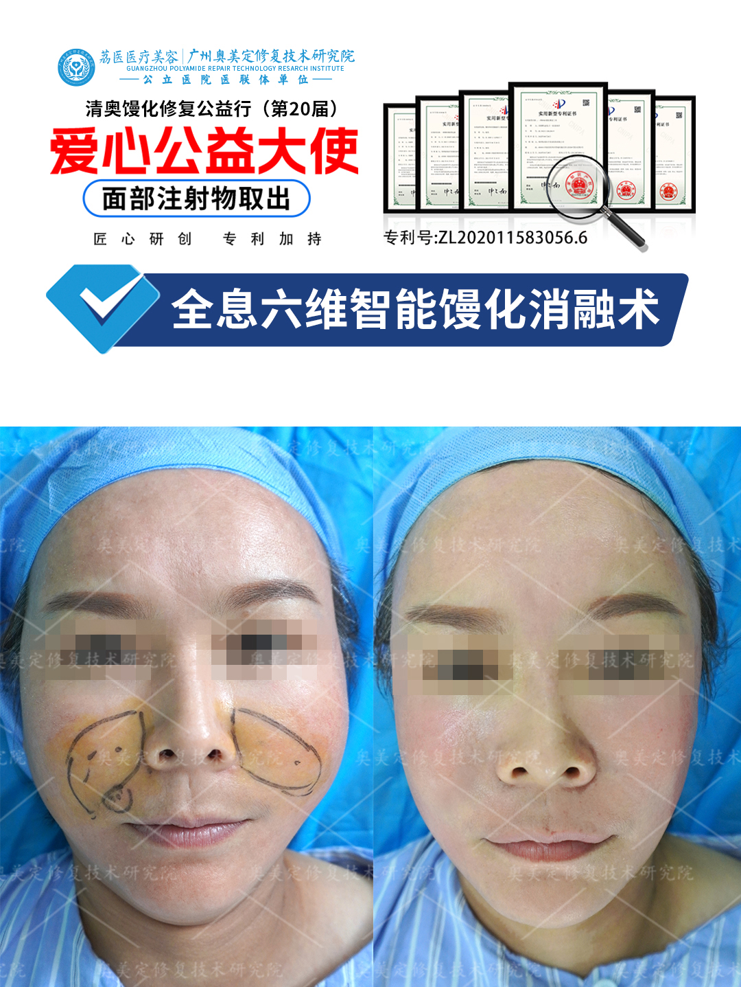 假玻尿酸怎么取出来