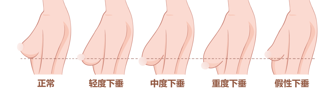 除了丰胸外，胸部整形还包含哪些项目？