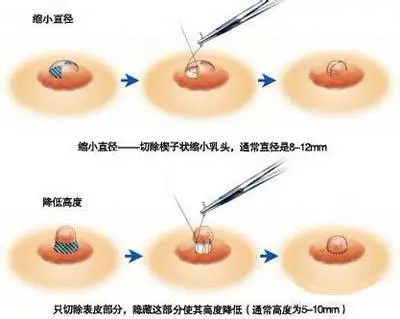 除了丰胸外，胸部整形还包含哪些项目？