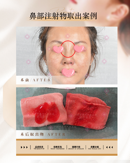 奥美定隆鼻后如何取出