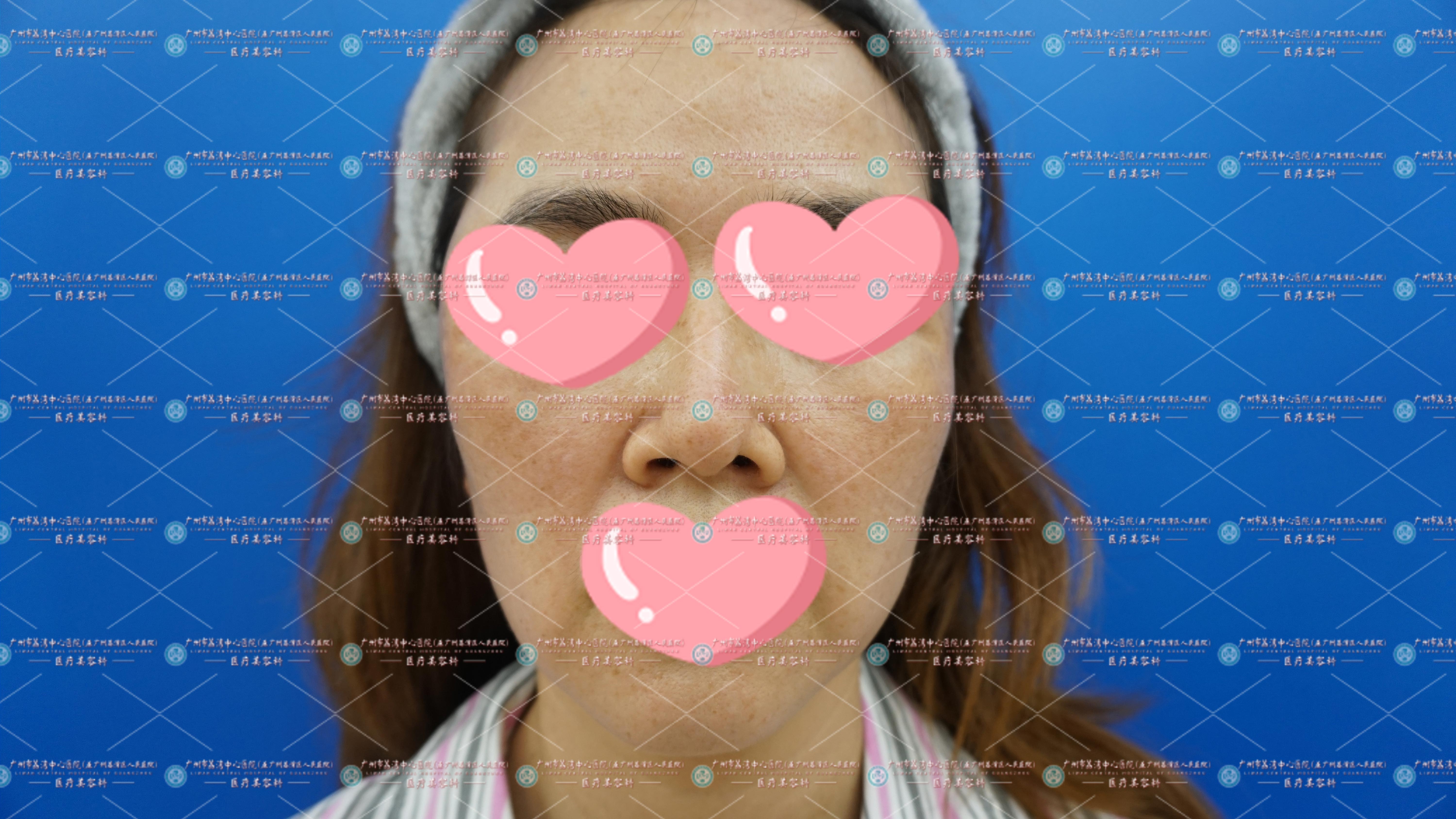 苹果肌、额头多次注射填充，肿的像“馒头”一样，软绵绵的没有美感