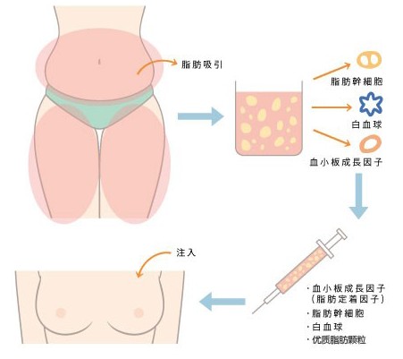 隆胸哪种方式最安全？