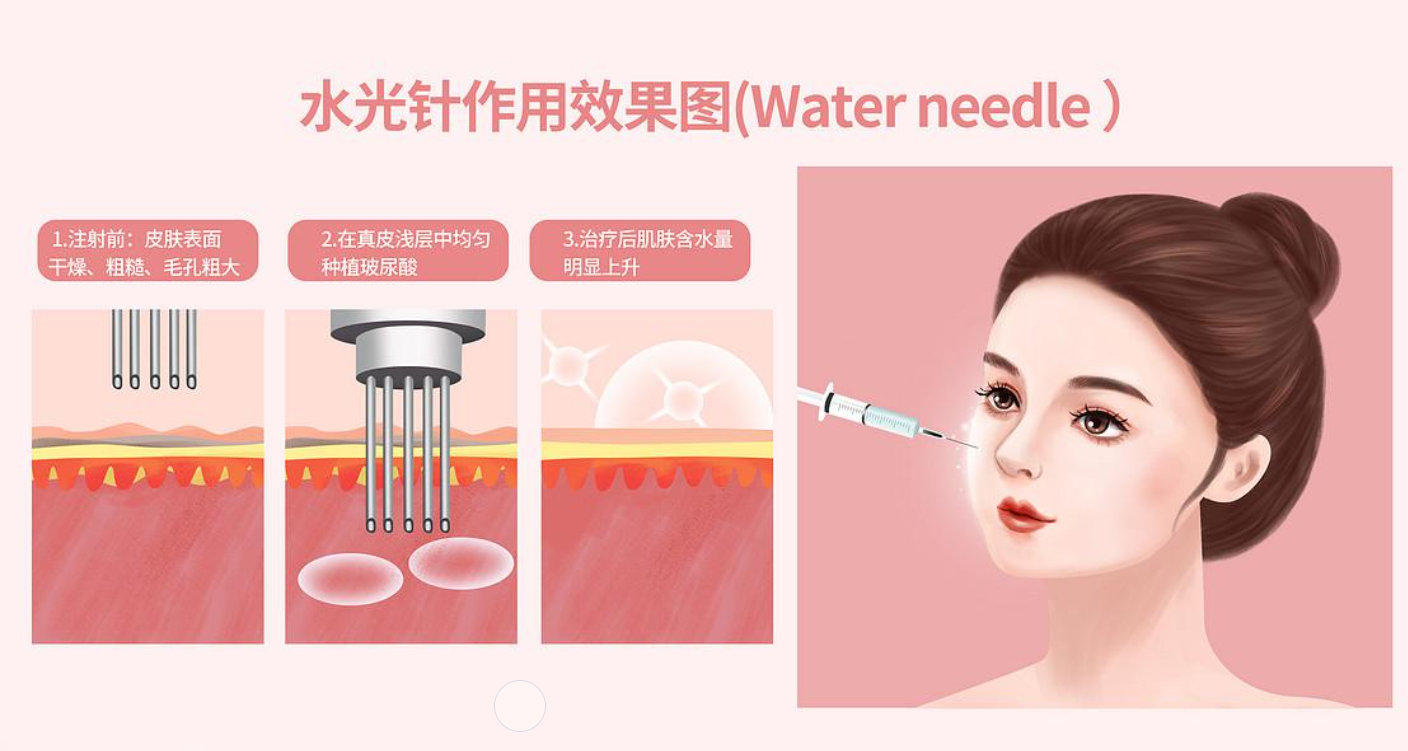 注射完水光针后应该怎么护理？