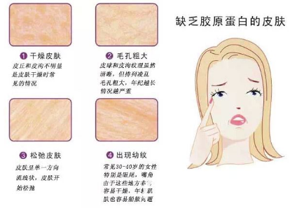 胶原蛋白玻尿酸哪个填充效果好