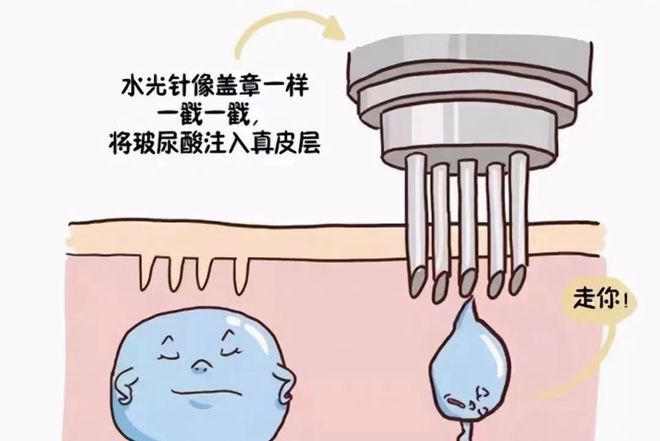 水光针和光子嫩肤，哪个更全面