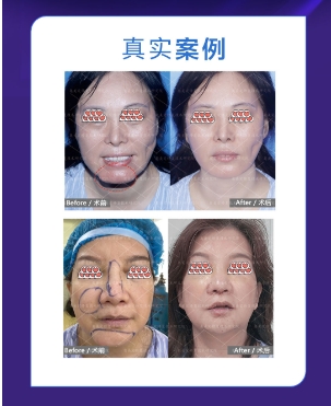 SEEK频谱智能清除术馒化脸