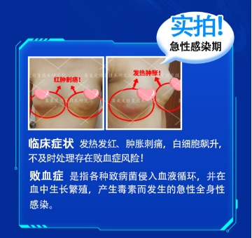一次意外后的重生：捷克水分子取出实录