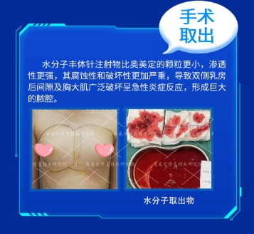 一次意外后的重生：捷克水分子取出实录