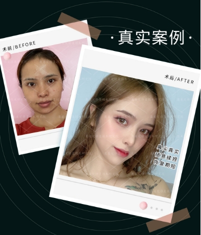 隆鼻一个月和三个月的差别