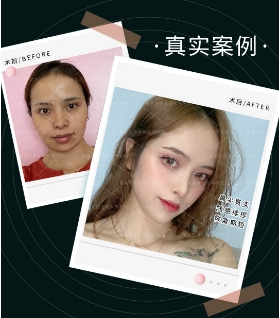 取鼻子假体大概需要多少钱