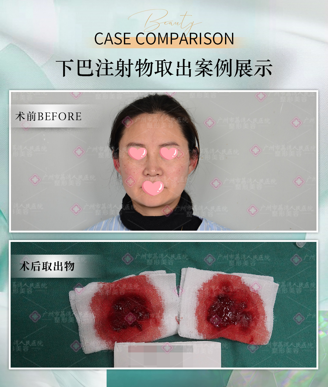 生长因子注射后没症状是被身体吸收了吗？