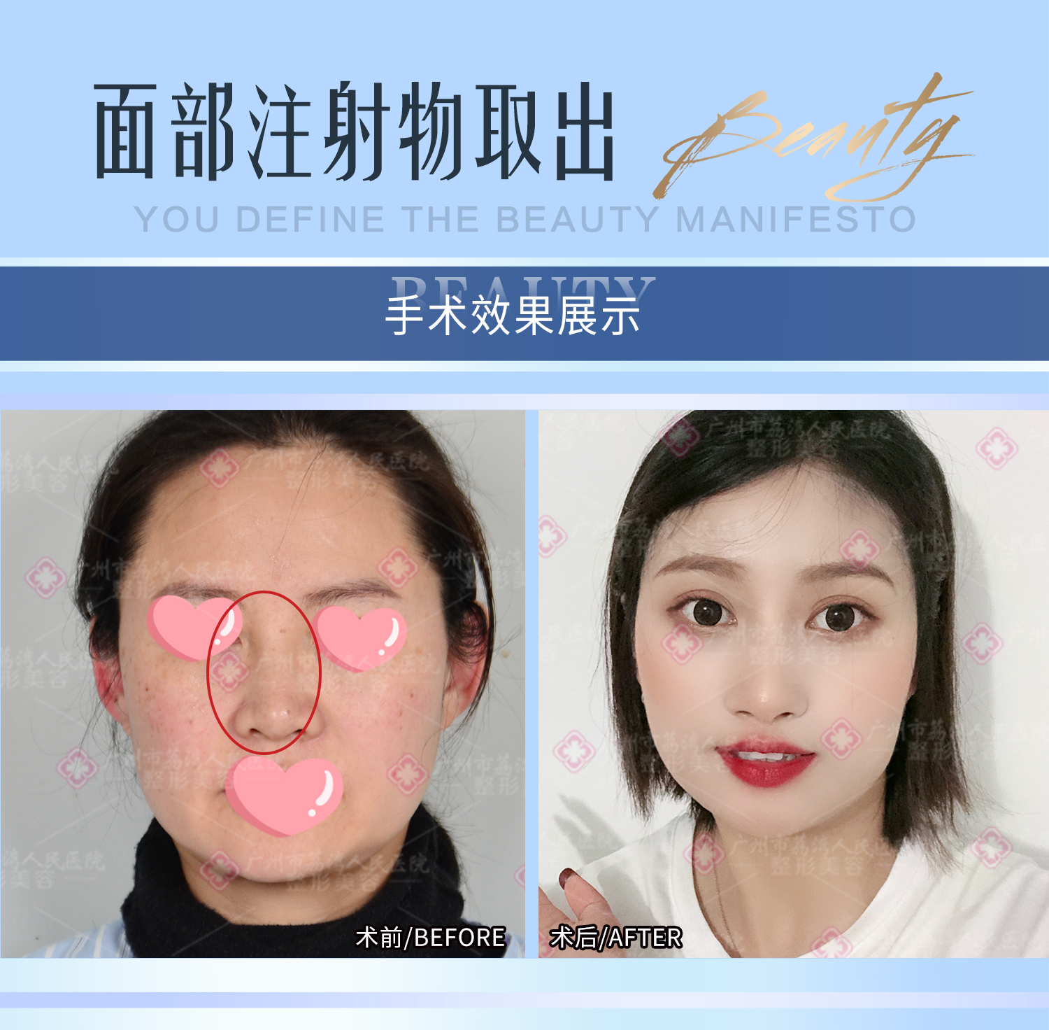 假玻尿酸可以溶解吗？玻尿酸溶解不了怎么办？
