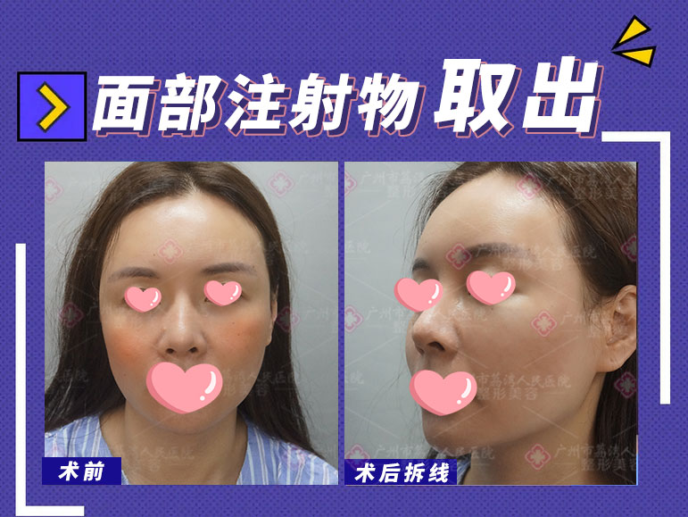 去正规医院取出奥美定需要花多少钱?